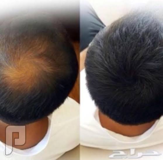 مدة وضع الزيت على الشعر