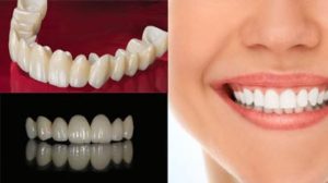 انواع تجميل الاسنان