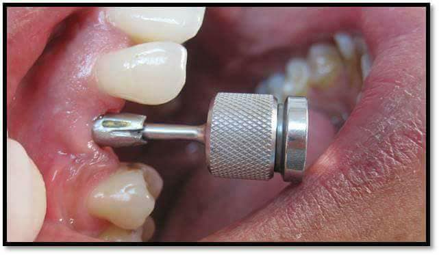 زراعة الاسنان الفورية