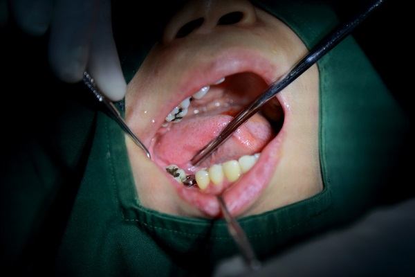 زراعة الاسنان الفورية في تركيا