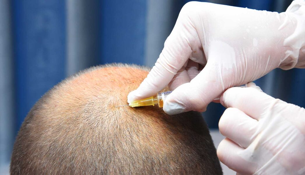 تكلفة علاج الشعر بالبلازما