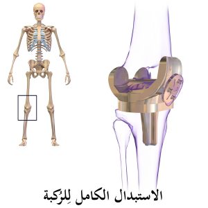 انواع مفصل الركبة الصناعية
