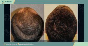 فوائد البلازما بعد زراعة الشعر