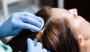 متىهل يفيد حقن البلازما للشعريمكن غسل الشعر بعد البلازما