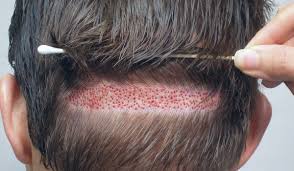 ومن أحدث طرق علاج الشعر علاج الشعر بالخلايا الجذعية