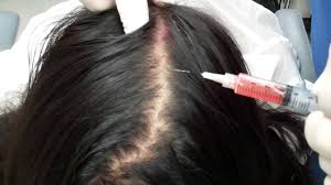 مراكز علاج تساقط الشعر في الرياض