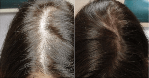 زراعة الشعر للنساء في تركيا .تجارب