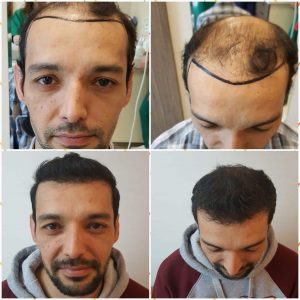 أسماء مستشفيات زراعة الشعر في تركيا